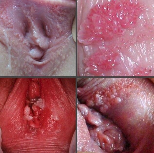 Gros plan du papillome dans le vagin
