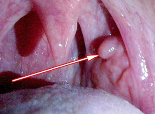 Papillome du larynx